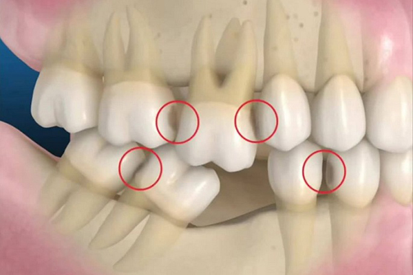 Già hơn tuổi thật do mất răng lâu năm !