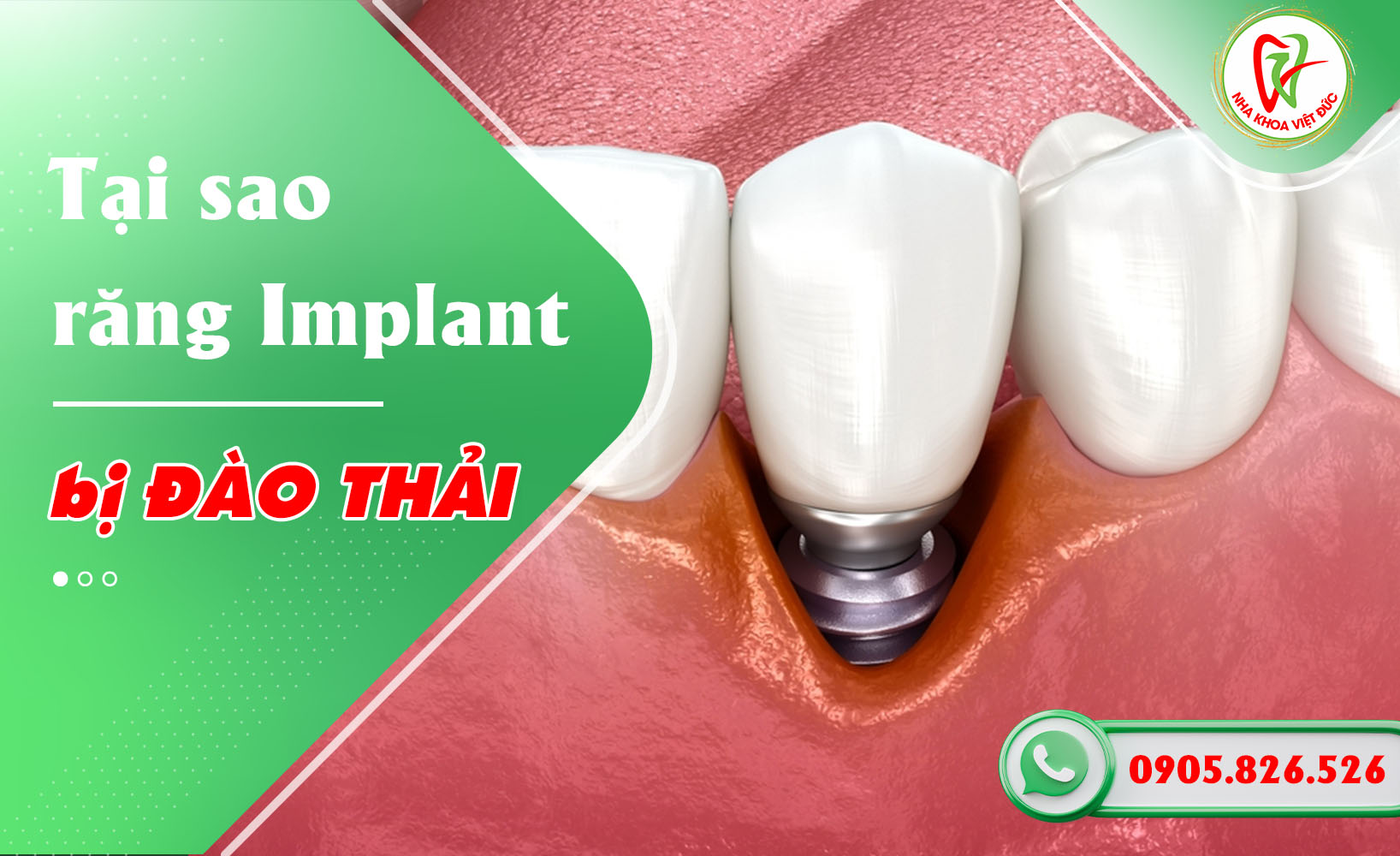 TẠI SAO RĂNG IMPLANT BỊ ĐÀO THẢI?