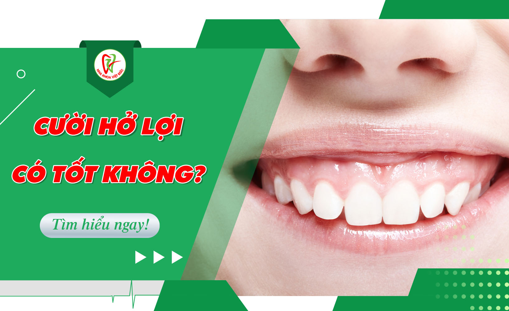 CƯỜI HỞ LỢI CÓ TỐT KHÔNG?