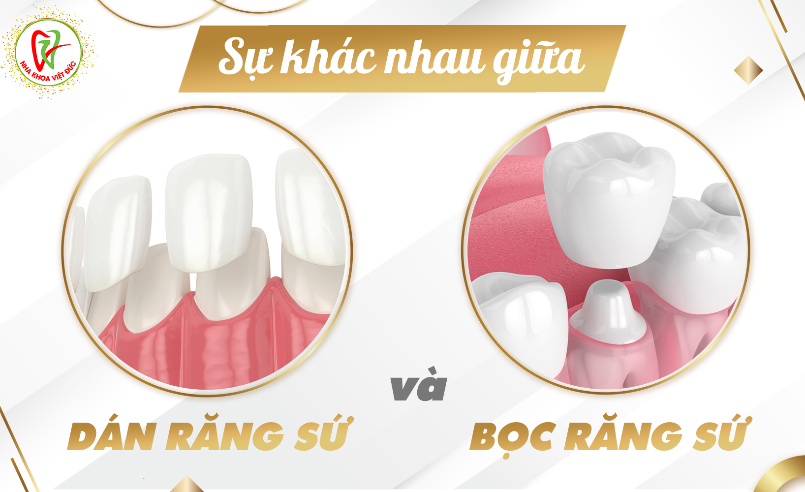 SỰ KHÁC NHAU GIỮA DÁN RĂNG SỨ VÀ BỌC RĂNG SỨ