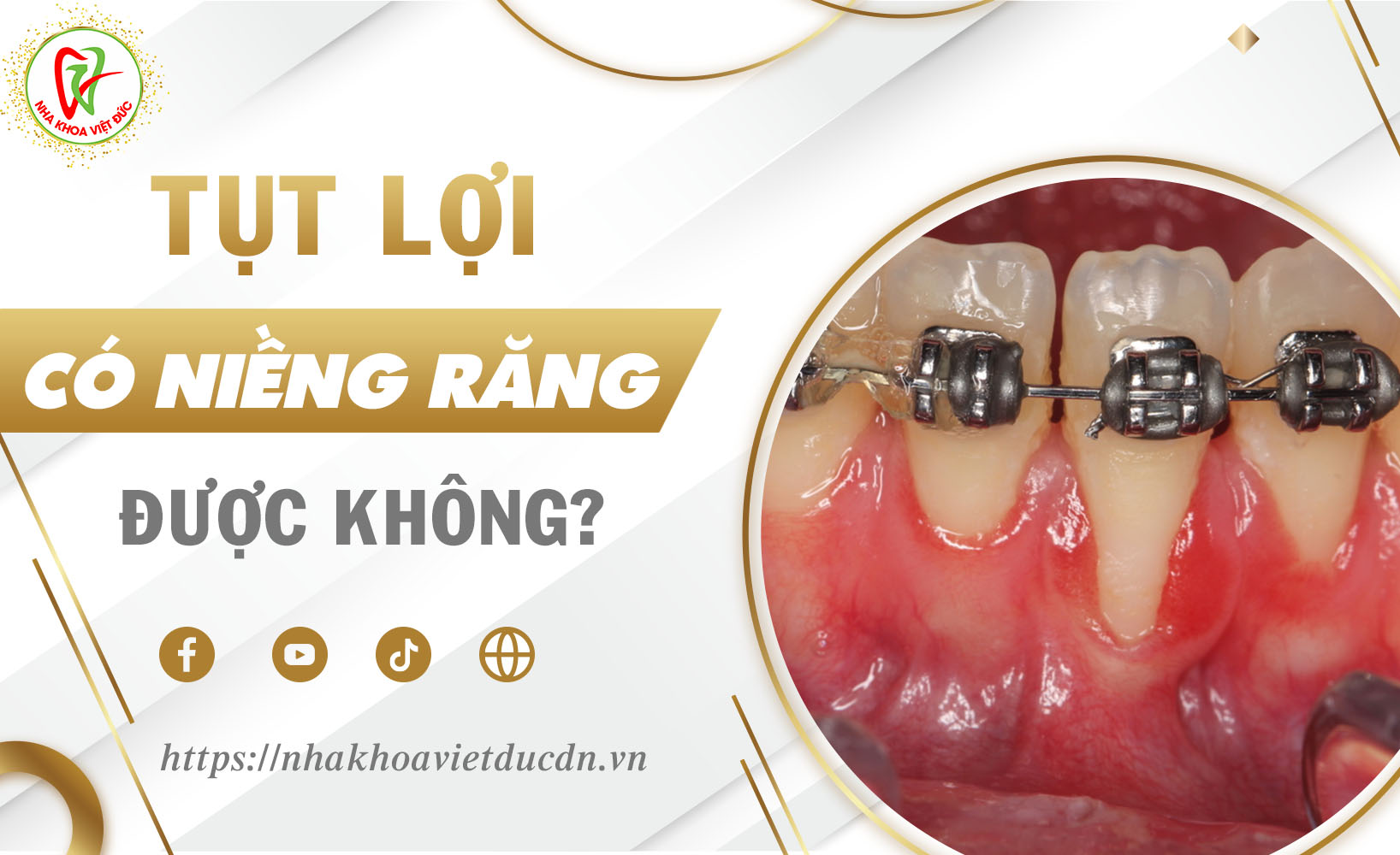 TỤT LỢI CÓ NIỀNG RĂNG ĐƯỢC KHÔNG?