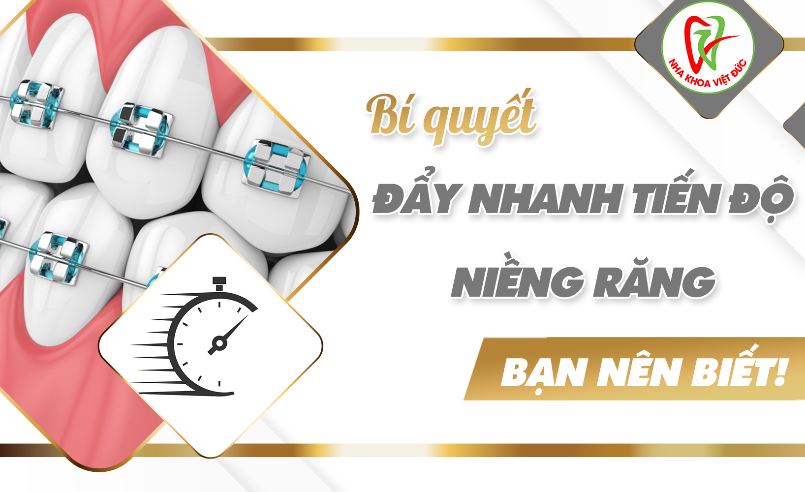 Bí quyết đẩy nhanh tiến độ niềng răng bạn nên biết!