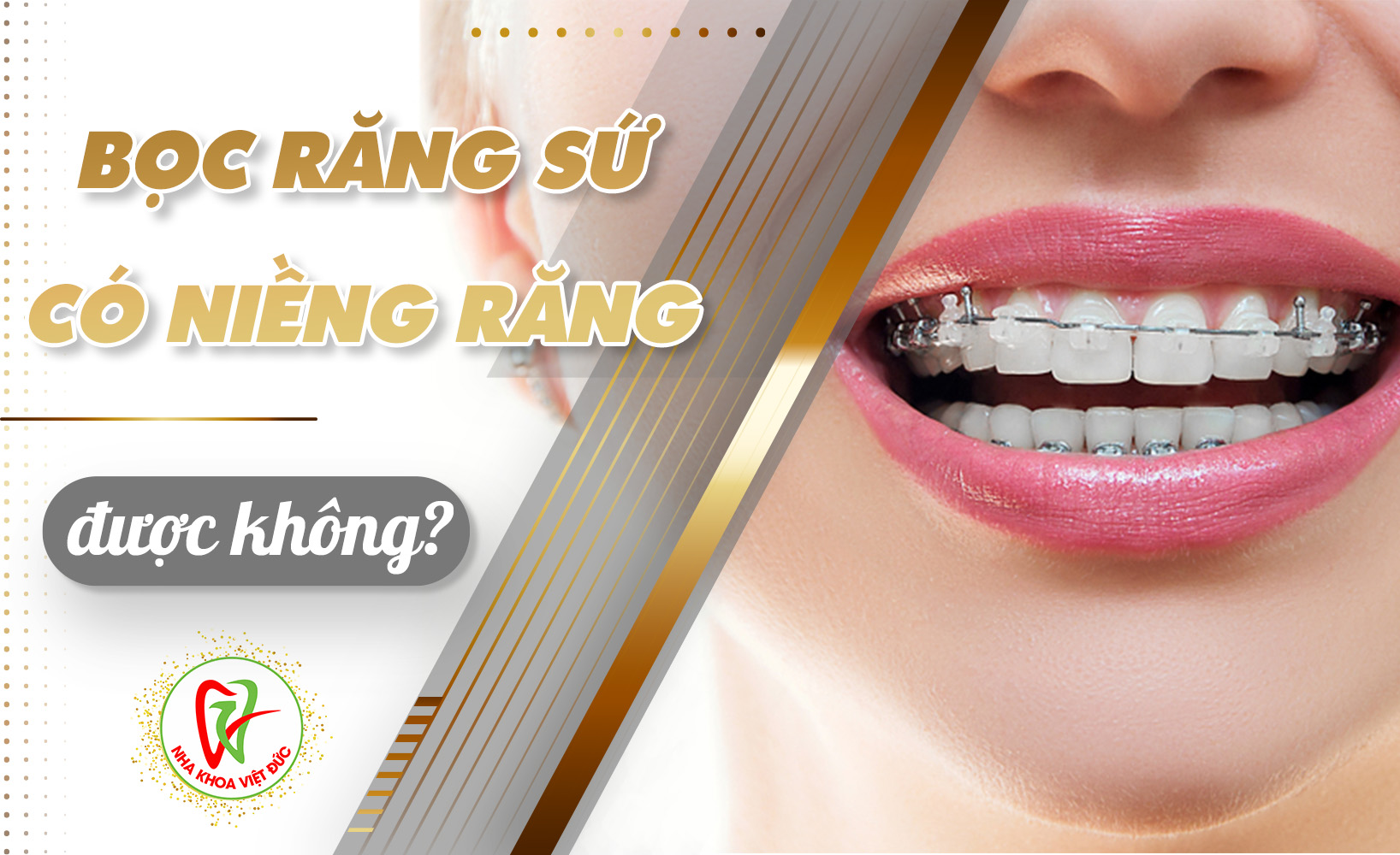 BỌC RĂNG SỨ CÓ NIỀNG RĂNG ĐƯỢC KHÔNG?