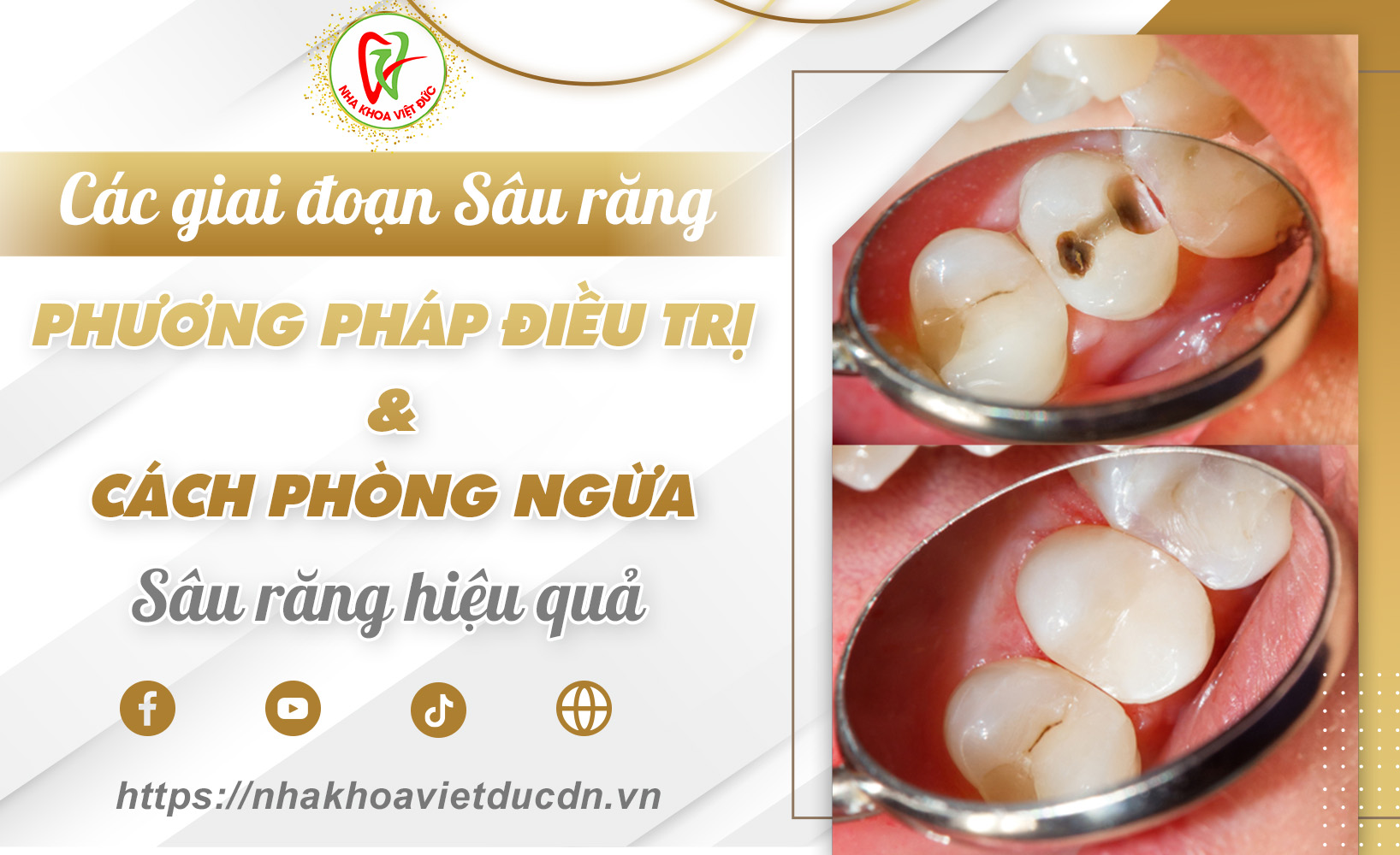 CÁC GIAI ĐOẠN, PHƯƠNG PHÁP ĐIỀU TRỊ VÀ CÁCH PHÒNG NGỪA SÂU RĂNG HIỆU QUẢ