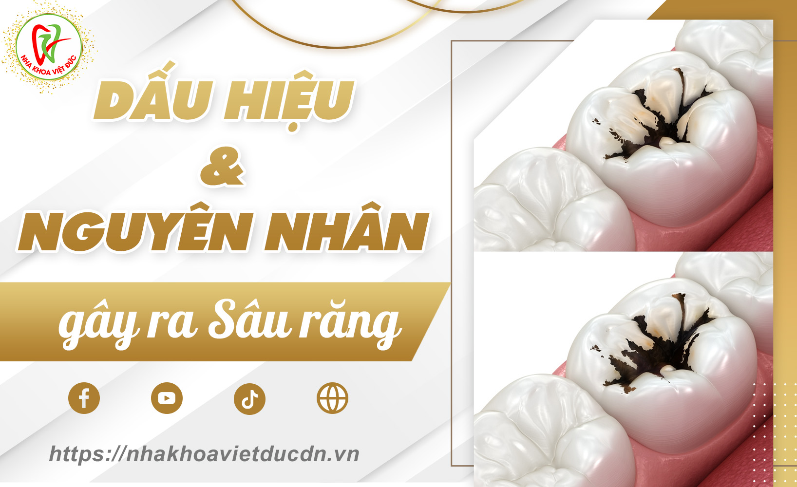 DẤU HIỆU VÀ NGUYÊN NHÂN GÂY RA SÂU RĂNG