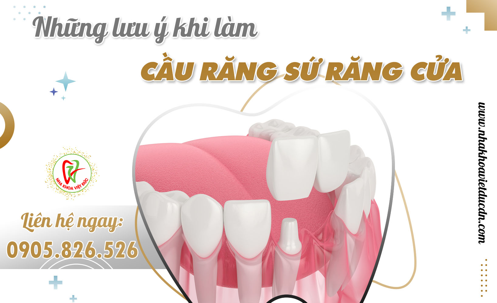 NHỮNG LƯU Ý KHI LÀM CẦU RĂNG SỨ RĂNG CỬA