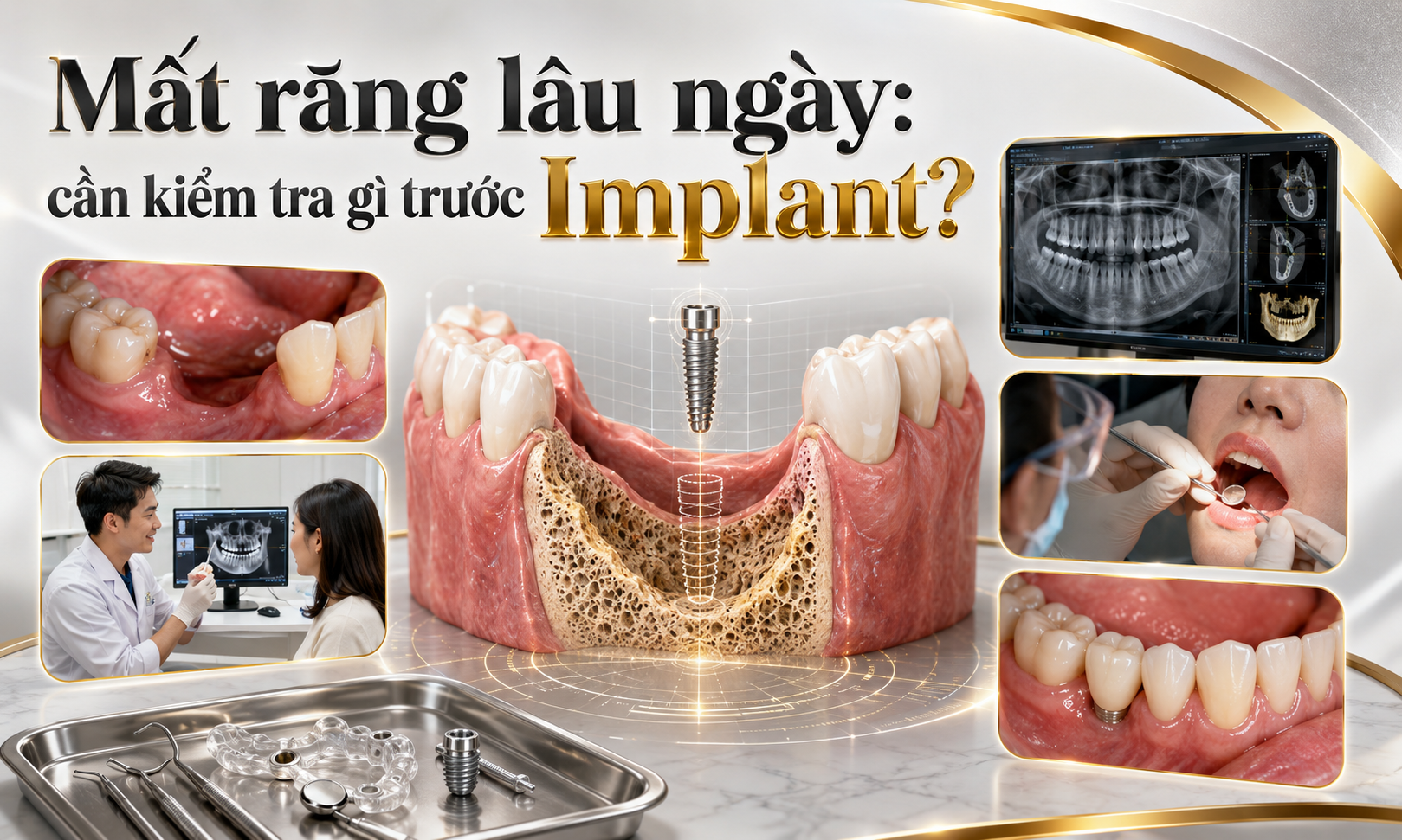 Quy trình kiểm tra trước khi cân nhắc Implant